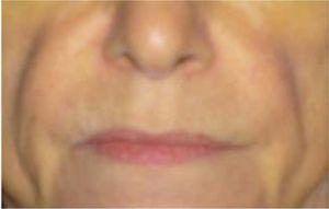 Marked facial lipodystrophy in patient with alcohol-related liver disease due to protein-energy malnutrition.