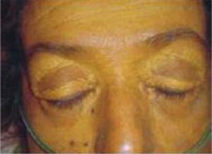 Bilateral xanthelasmata of upper eyelids (Macias-Rodri-guez RU, Torre-Delgadillo A. Xanthelasmas and xanthomatas striatum palmare in primary biliary cirrhosis. Ann Hepatol. 2006 Jan-Mar; 5: 49, with permission).