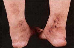 Polyarteritis nodosa - multiple, confluent, dermal and subcutaneous nodules with ulceration on the medial aspect of the lower legs (from Color Atlas & Synopsis of Clinical Dermatology, 4the, Fitzpatrick et al., with permission).