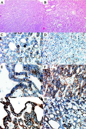 Light microscopy and immunohistochemistry. The tumour showed both a trabecular (A) and tubuloglandular architecture (B). Immunohistochemistry showing positive staining for: synaptophysin (C), chromogranin (D), CD56 (E), MOC-31 (F), CK-7 (G) and CK-19 (H).
