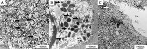 Electron microscopy. Electron dense neurosecretory granules (black arrows) ranging in size from 220-350 nm were seen within the cytoplasm of tumour cells in areas of both trabecular (A) and tubuloglandular architecture (B). Cells lining the tubuloglandular components of the tumour (C) showed luminal microvilli (white arrow) and tight junctions (black arrow).