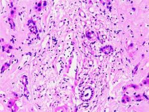 H&E stain of the hepatic tissue showing diffuse amyloid deposition. Eosinophilic amyloid materials are diffusely present in extracellular matrix, such as hepatic sinusoids, portal area, and vessel walls. Hepatic plates are distorted and hepatocytes atrophy. Original magnification: ×400.