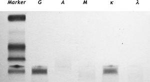 Abnormal protein bands for increased gamma globulin, immunoglobulin G (IgG) and kappa light chain. The presence of an IgG kappa band in the gamma region was shown on serum immunofixation electrophoresis (IFE).
