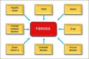 Shows several causes of hepatic fibrosis: viral infection is most common (hepatitis B and C). Nonalcoholic steatohepatitis (NASH). Also liver fibrosis is associated with the consumption of alcohol, or autoimmune hepatitis and chronic cholangiophaties.
