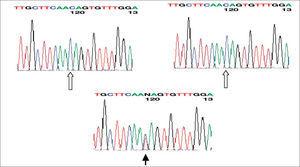 Secuenciación del IRE del gen de la L-ferritina: se muestra la presencia de las dos bases normales de citosina en los padres (flechas blancas) en la posición 39; en el hijo aparece una base de cromosoma normal y otra anormal de tirosina (mutación de novo) en dicha posición (flecha negra).