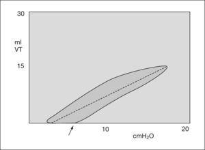 Gráfico de volumen-flujo. Distensibilidad baja. VT: volumen tidal.