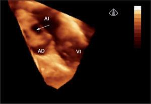 Ecocardiografía 3D en tiempo real desde la aurícula derecha que permite la visualización “de frente” del defecto interauricular tipo ostium secundum (flecha) y bordes adyacentes. AD: aurícula derecha; AI: aurícula izquierda; VI: ventrículo izquierdo.