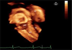 Ecocardiografía 3D en tiempo real con visión desde la aurícula derecha del dispositivo Amplatzer (flecha), oclusor de la comunicación interauricular tipo ostium secundum. AD: aurícula derecha; AI: aurícula izquierda; VD: ventrículo derecho; VI: ventrículo izquierdo.