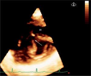 Ecocardiografía 3D en tiempo real vista desde la cara ventricular proyección eje corto del cleft mitral (flecha): se observa la hendidura mitral en toda su extensión. VI: ventrículo izquierdo.