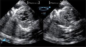 Modo biplano fetal en un corazón normal. Desde una proyección apical, con cuatro cámaras y con una única ventana acústica, con una inclinación vertical, se ha obtenido simultáneamente el plano ecocardiográfico fetal “tres vasos” con la vena cava superior, aorta y pulmonar bifurcándose en sus dos ramas. A: aorta; AD: aurícula derecha; AI: aurícula izquierda; P: arteria pulmonar; VCS: vena cava superior.