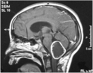 Corte sagital de RM. Astrocitoma cerebeloso intervenido con destrucción del tronco encefálico.