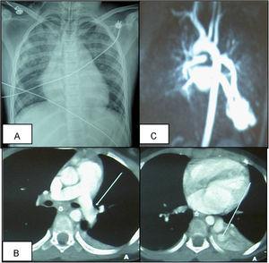 A) Angio-TC pulmonar. B) Angio-RM torácica. C) Embolización angiográfica y Rx de tórax postembolización.