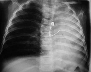 Radiografía de tórax anteroposterior. Imperdible abierto con atelectasia masiva del pulmón izquierdo y derrame pleural ipsilateral.