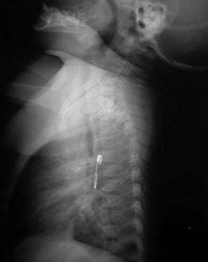 Radiografía de tórax lateral. Cuerpo extraño intraesofágico (localización posterior a la tráquea).