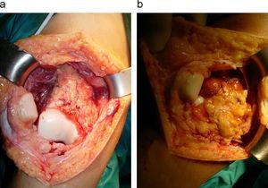Imagen intraoperatoria. Artrotomía de rodilla. a) aspecto de la lesión. b) posresección completa.
