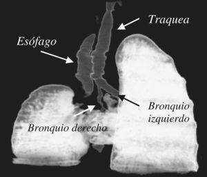 TC con reconstrucción tridimensional en el que se aprecian la vía aérea y ambos pulmones: 1) traquea, bronquio izquierdo normal, bronquio derecho de escaso calibre, 2) pulmón derecho hipoplásico con agenesia del lóbulo superior derecho, 3) istmo pulmonar uniendo ambas bases pulmonares que es característico del pulmón en herradura.