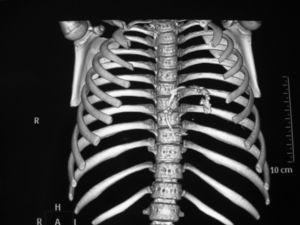 TAC Multicorte. Reconstrucción del plano frontal que muestra el surco AV calcificado.