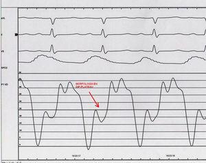 Cateterismo cardiaco. Morfología en Dip-Plateu en la curva de presiones del ventriclo derecho.