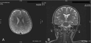 A) Caso 1: RM craneal, corte axial, T2: muestra escasa mielinización a la edad de 2 años. B) Caso 4: RM craneal, corte coronal, T2: se visualiza una atrofia cortico-subcortical supratentorial.