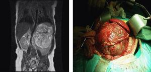 Resonancia magnética nuclear abdominal en la que se aprecia la gran masa retroperitoneal con desplazamiento de estructuras mediales.