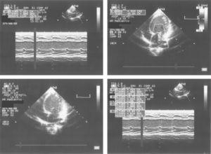 Ecocardiografía en unidad de cuidados intensivos en la que se aprecia importante dilatación de ventrículo izquierdo con moderada-severa depresión de la función sistólica (fracción de eyección=35–40%) e insuficiencia mitral central por dilatación del anillo.