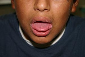 Caso 1. Lesiones tuberosas excrecentes del color de la mucosa normal en los bordes laterales de la lengua.