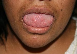 Caso 2. Lesiones papulosas que confluyen formando placas en semimucosas labiales y lengua.