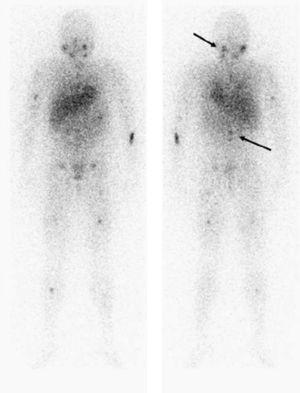Imágenes del rastreo con 123I-MIBG, en el que se evidencian múltiples depósitos patológicos osteomedulares localizados en la base craneal izquierda, columna vertebral, pelvis y esqueleto apendicular.