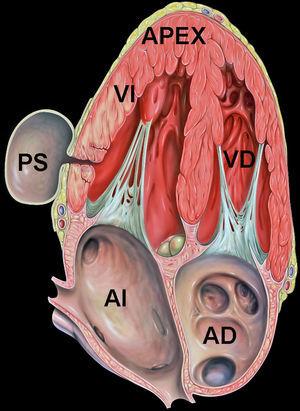 Esquema equivalente a imágen de un pseudoaneurima localizado en la pared libre del VI. En este caso no es localización apical pero nos permite diferenciar las estructuras anatómicas perfectamente. PS: significa pseudoaneurisma; VI: ventrículo izquierdo; VD: ventrículo derecho: AI: aurícula izquierda; AD: aurícula derecha; APEX: ápex.