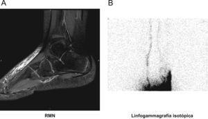 A) Aumento del tejido celular subcutáneo localizado en la vertiente dorsal y lateral del pie con trabeculación. B) Migración retrasada y disminuida del trazador a nivel del sistema linfático del miembro inferior izquierdo.