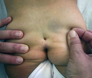 Fotografía de un caso reciente de una niña de 3 años con seno sacrocoxígeo.