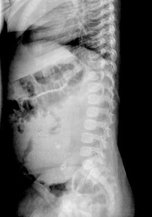 Imágenes de radiología abdominal. Masa retroperitoneal izquierda que desplaza las asas intestinales, con contenido cálcico en su interior.