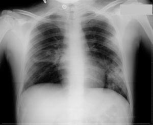 Infiltrados pulmonares en el hemitórax izquierdo. Lesión cavitada en el hemitórax derecho.