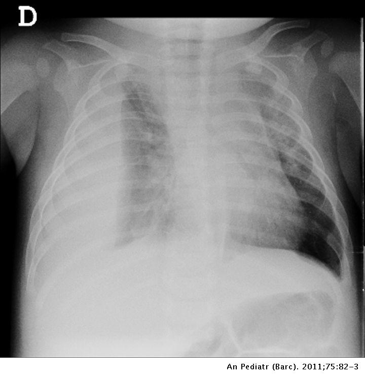 Videos Que Es Neumonia Con Derrame Pleural viral Videos Que Es Neumonia Con Derrame Pleural viral