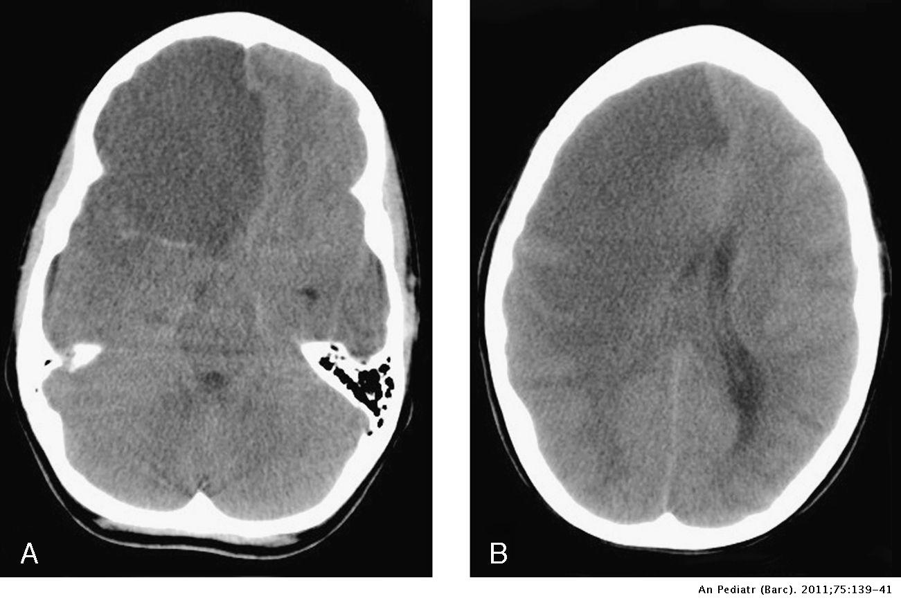 Piñón entrevista Articulación Craniectomía descompresiva en infarto cerebral maligno | Anales de Pediatría
