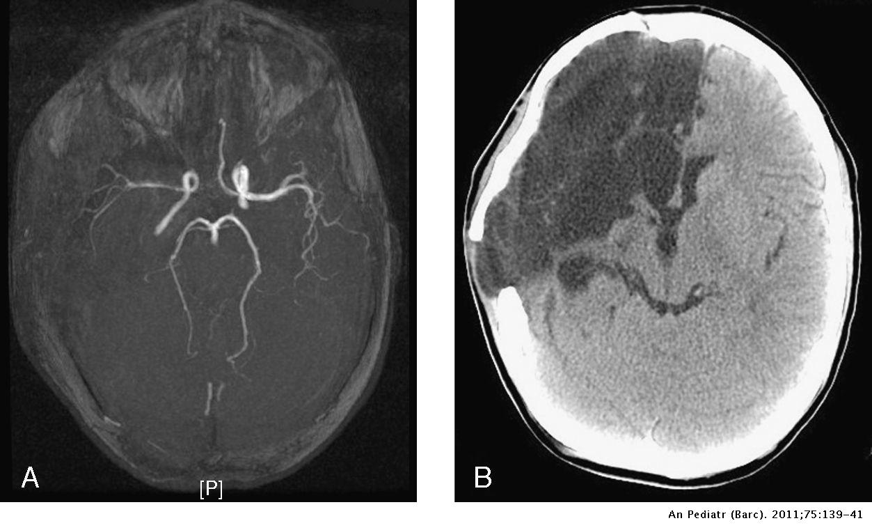 Piñón entrevista Articulación Craniectomía descompresiva en infarto cerebral maligno | Anales de Pediatría