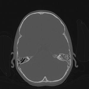 Imagen de TC craneal del caso 1. Se observa ocupación de las celdas etmoidales, senos frontales, senos esfenoidales, cajas timpánicas, aditus y antro mastoideo izquierdo.
