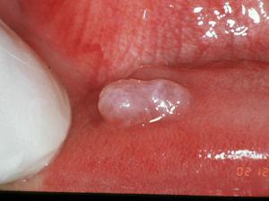 Mucocele oral congénito en la mucosa del labio inferior.