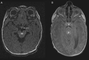 Axial 3D FSPGR IR. A) Se aprecia claramente la imagen nodular con elevada señal (neurohipófisis) en la parte posterior del quiasma (flecha blanca) a la altura del mesencéfalo (m). B) Paciente normal en el que la neurohipófisis se aprecia en la parte posterior de la silla turca. p: puente.