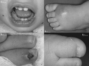 A: Erosiones orales compatibles con estomatitis herpética, en fase de resolución. B: Panadizo herpético. C: Lesión cutánea abscesificada en pie izquierdo. D: Descamación periungueal del primer dedo.