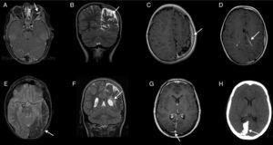 Ejemplos de anomalías de neuroimagen. A) Caso 1, RM, corte axial, secuencia en T1 con contraste: angioma de la coroides a la izquierda (flecha). B) Caso 4, RM, corte coronal, secuencia en T2: calcificaciones corticales y atrofia parietooccipital a la izquierda (flecha). C) Caso 4, RM, corte axial, secuencia en T1 con contraste: angiomatosis pial (flecha) y atrofia cortical a la izquierda, con asimetría hemisférica y de la calota craneal. D) Caso 4, RM, corte axial, secuencia en T1 con contraste: angiomatosis pial, angioma del plexo coroideo (flecha) y atrofia cortical a la izquierda. E) Caso 10, RM, corte axial, secuencia T2: calcificaciones y atrofia del hemisferio izquierdo, gliosis del parénquima adyacente (flecha); dilatación de vena prepontina. F) Caso 10, RM, corte axial, secuencia en T2: calcificaciones y atrofia parietal a la izquierda; plexo coroideo mayor a la izquierda (flecha). G) Caso 11, RM, corte axial, secuencia en T1, con contraste: área encefaloclástica cortico-subcortical parieto-occipital, angiomatosis pial y plexo venoso más prominente a la derecha (flecha). H) Caso 11, TC, corte axial, sin contraste: calcificaciones corticales parieto-occipitales a la derecha (flecha).
