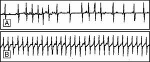 Registro ECG-Holter del paciente. A) Salvas de taquicardia supraventricular autolimitadas. B) Taquicardia supraventricular mantenida (250 lpm).