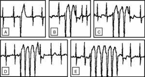 Registro ECG-Holter del paciente. A, B) Extrasístoles ventriculares aisladas y en parejas. C, D y E) Taquicardia ventricular no sostenida de hasta 5 latidos.