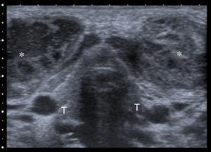 Ecografía cervical: lóbulos tiroideos normales (T) y delante de ellos 2 masas adenopáticas con zonas hipoecoicas en su interior (*).