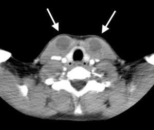 TC cervical: tumoraciones hipodensas redondeadas (flechas), de localización anterior al tiroides (*), de unos 18mm de diámetro la derecha y 14mm la izquierda, con mínima captación periférica y áreas de necrosis y abscesificación en su interior.