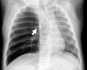 Radiografía de tórax: obsérvese el cuerpo extraño produciendo efecto valvular y atrapamiento aéreo derecho con desplazamiento mediastínico izquierdo.