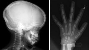 Radiografía lateral de cráneo y de la mano, observándose la acroosteólisis.