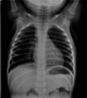 Radiografía anteroposterior de tórax.