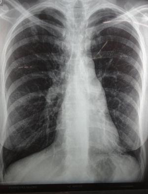 Radiografía de la madre del paciente. Se observa una imagen radiolúcida en el vértice izquierdo.
