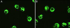 Anticuerpos anticitoplasma de neutrófilo. Patrón citoplasmático (C-ANCA) sobre neutrófilos fijados en etanol (A) y formalina (B).